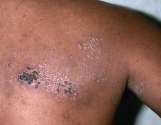 mụn nước zona khô, đóng vảy