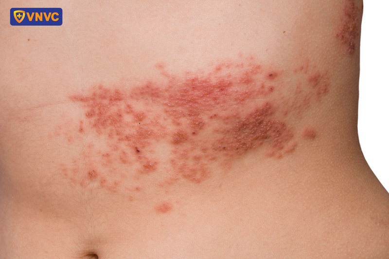 mụn nước zona thần kinh