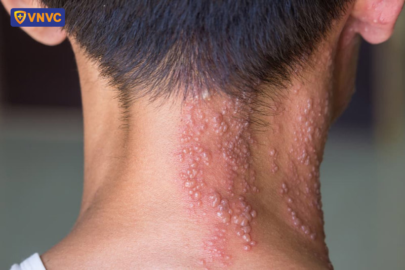 mụn nước zona thần kinh