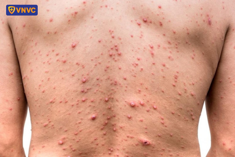 mụn thủy đậu trên da