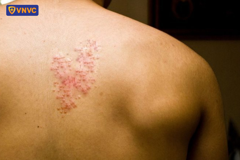 mụn zona hình thành các vảy