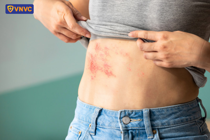 người lớn bị zona thần kinh