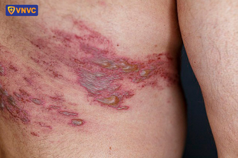 người mắc bệnh zona thần kinh