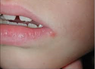 nhận biết herpes giai đoạn nguyên phát