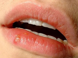 nhận biết herpes giai đoạn tiền triệu