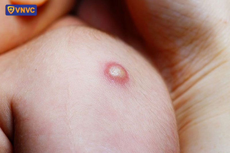 quầng đỏ và loét nhẹ