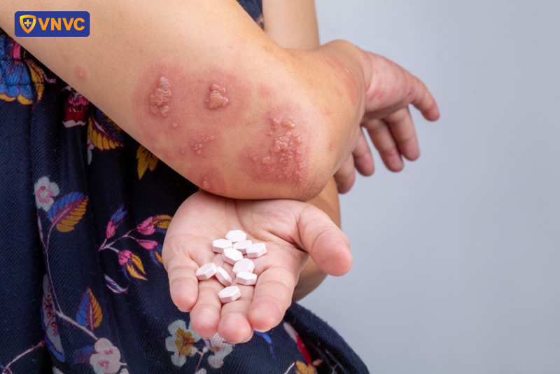 thuốc điều trị zona