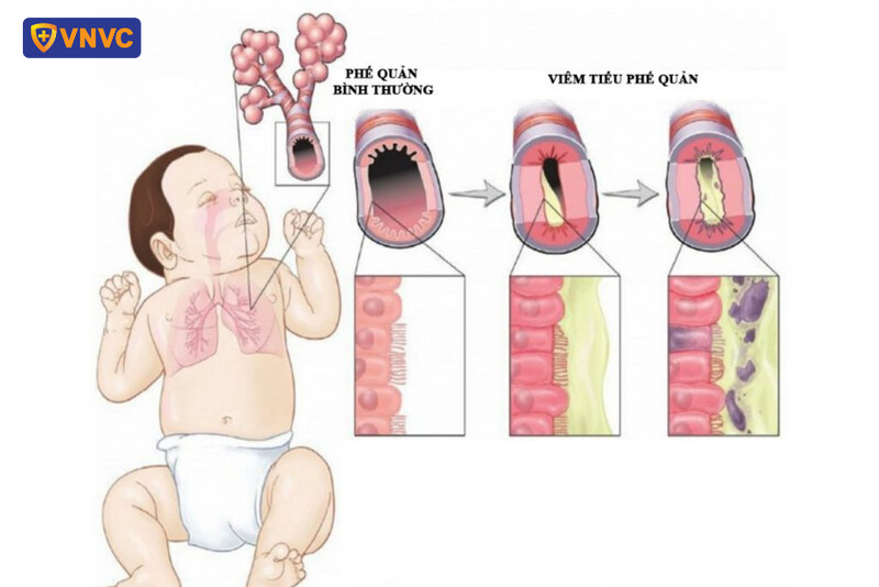 tình trạng viêm tiểu phế quản tắc nghẽn