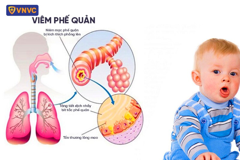 viêm phế quản rsv