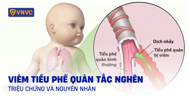 Viêm tiểu phế quản tắc nghẽn: Triệu chứng, nguyên nhân, phòng ngừa