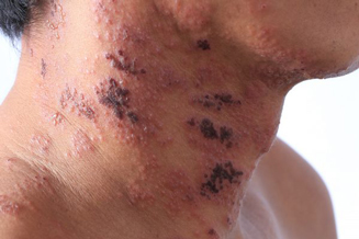 zona giai đoạn mãn tính