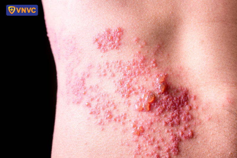 zona thần kinh bôi kem đánh răng được không