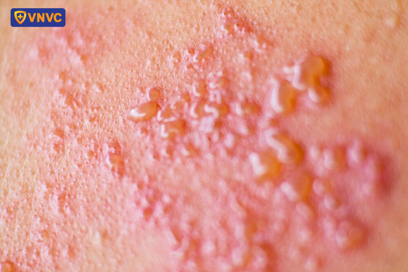 zona thần kinh ở mông