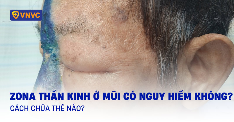 zona thần kinh ở mũi