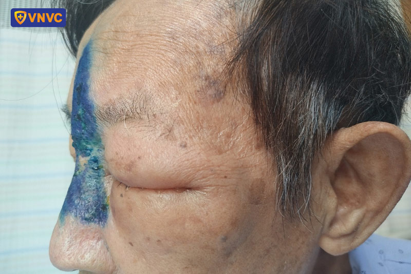 zona thần kinh ở vùng trán và mắt