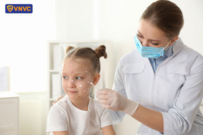 bệnh thuỷ đậu nổi nhiều ở mặt