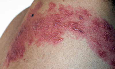 các nốt ban đỏ zona