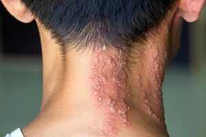 đặc trưng mụn nước zona thần kinh