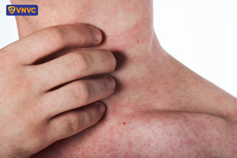 hình ảnh sốt xuất huyết giai đoạn hồi phục
