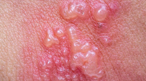 mụn nước zona