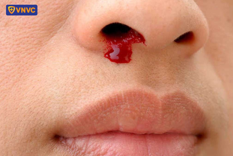 sốt xuất huyết gây chảy máu mũi
