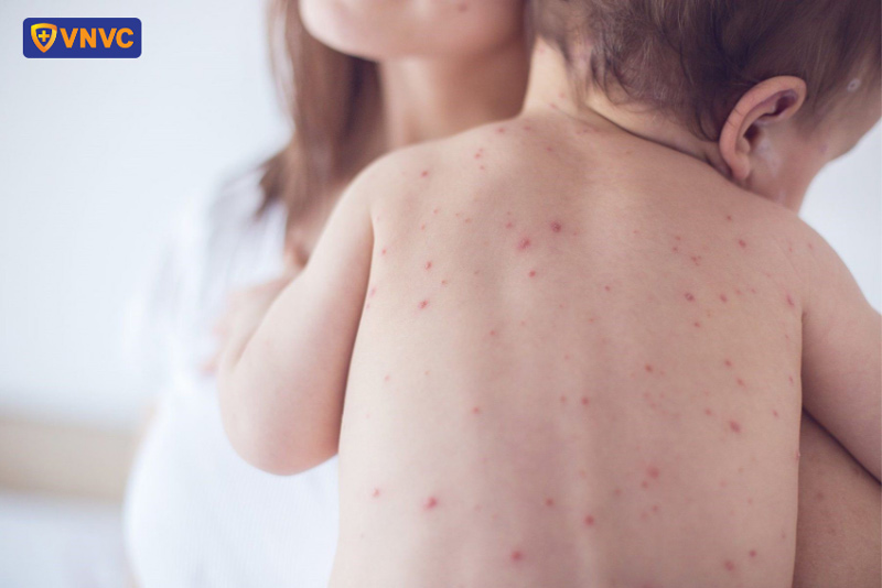 bệnh sốt xuất huyết có lây qua người không