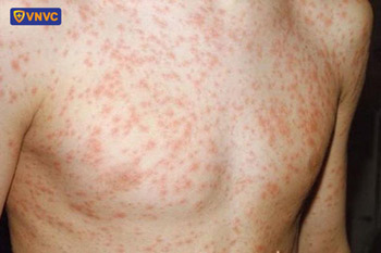 hình ảnh sốt phát ban