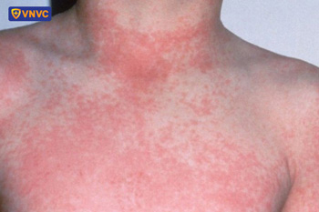 hình ảnh sốt siêu vi