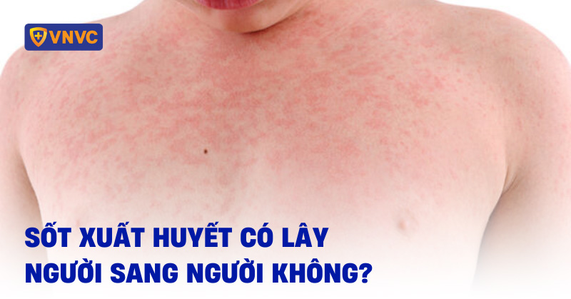 sốt xuất huyết có lây người sang người không