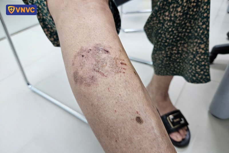 vết cắn của chó dại
