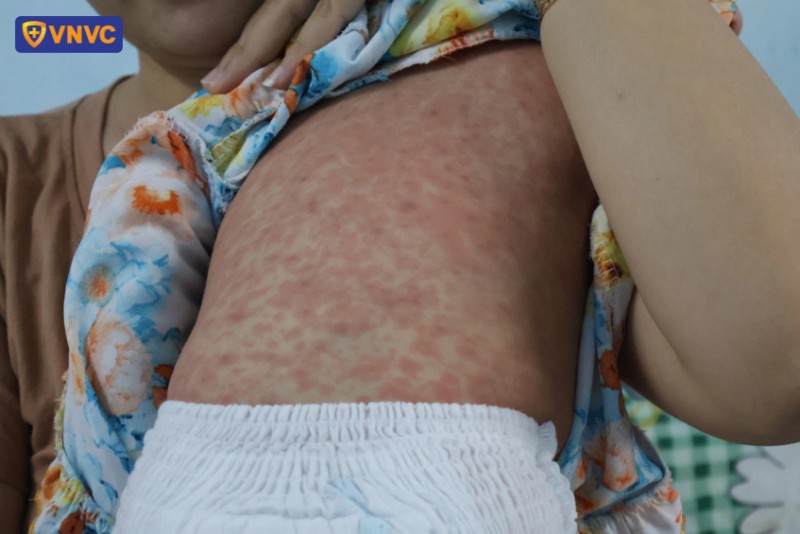 bệnh sởi ở trẻ