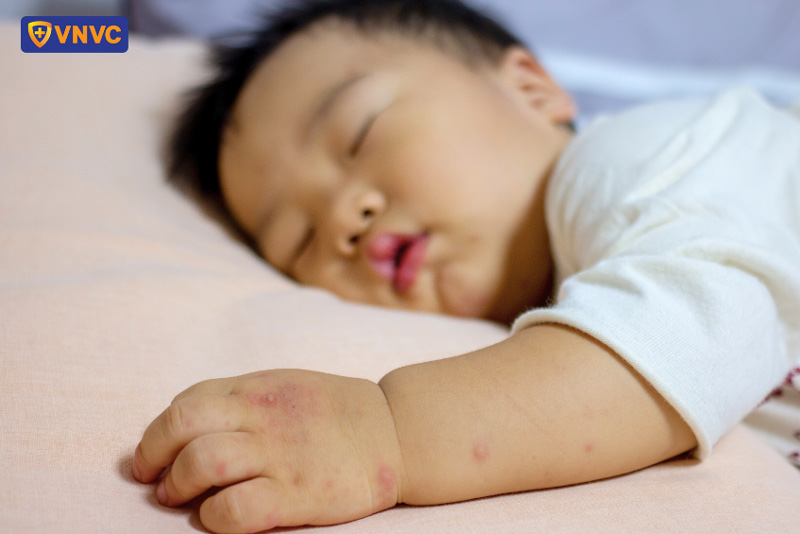 bị chân tay miệng có kiêng gió không