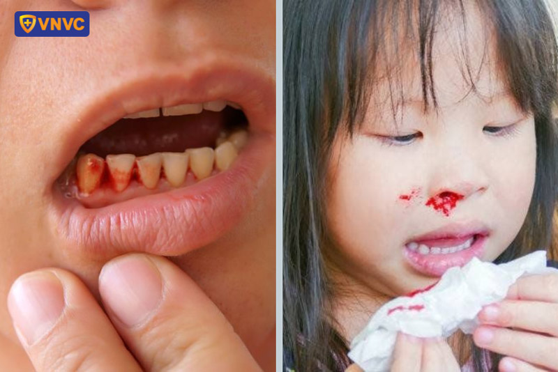 chảy máu do sốt xuất huyết