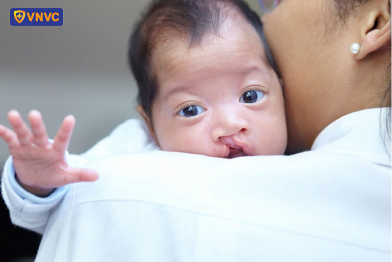 dị tật bẩm sinh hở hàm ếch