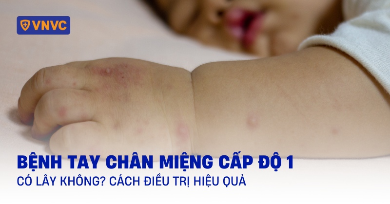 điều trị bệnh tay chân miệng cấp độ 1