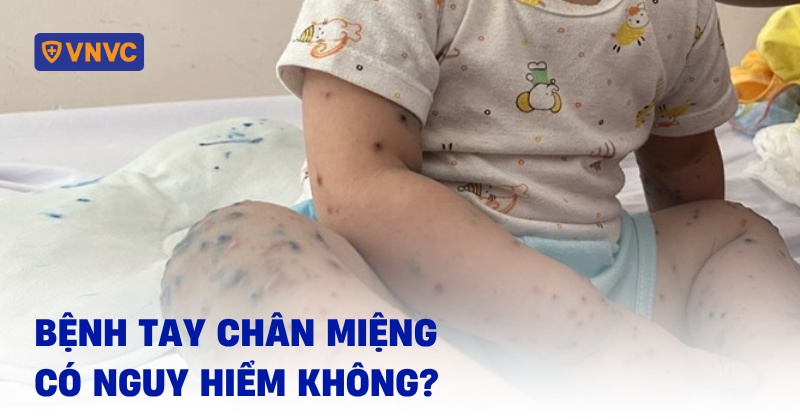 giải đáp bệnh tay chân miệng có nguy hiểm không