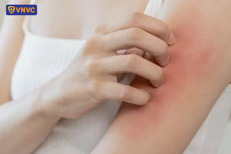 giảm ngứa sốt xuất huyết