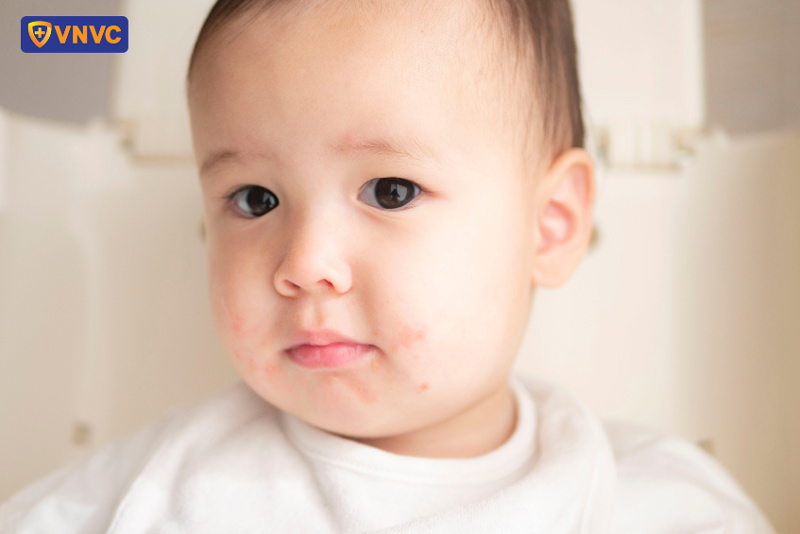 giữ vệ sinh cho trẻ bị tay chân miệng