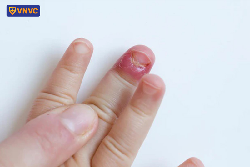 mất móng tay do tay chân miệng