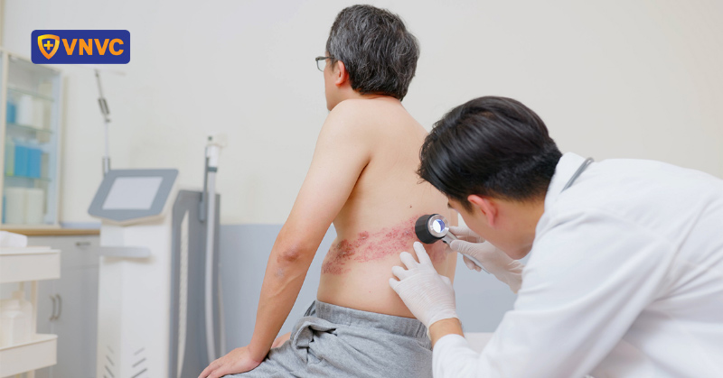 người lớn bị zona