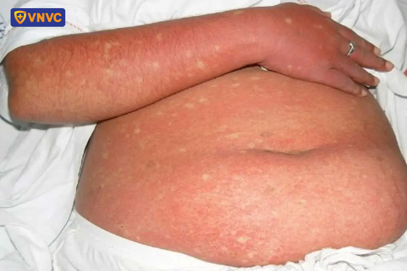 phát ban sốt xuất huyết