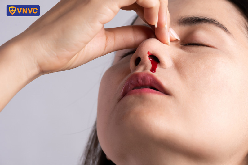 sốt xuất huyết bị chảy máu mũi
