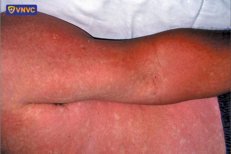 sốt xuất huyết bị đông máu có nguy hiểm không