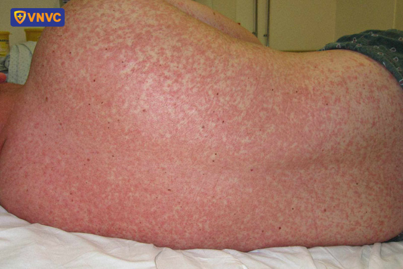 sốt xuất huyết đông máu có sao không