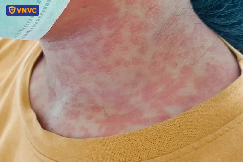 sốt xuất huyết đông máu