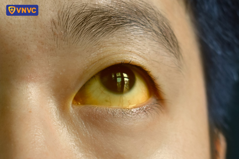 sốt xuất huyết gây tổn thương gan