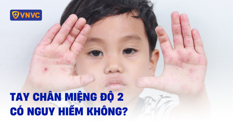 tay chân miệng độ 2