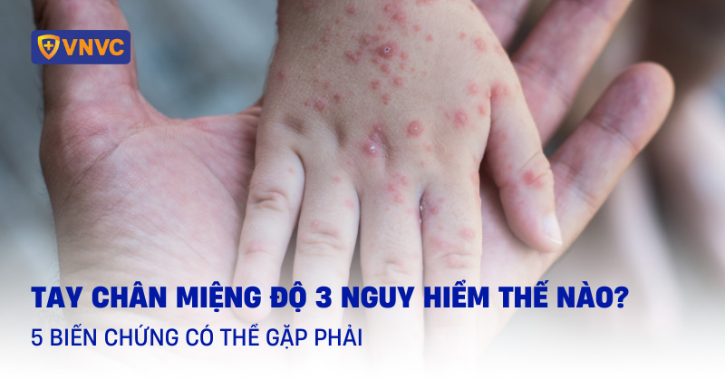 tay chân miệng độ 3