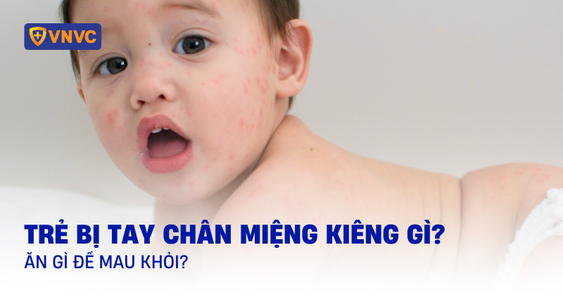 tay chân miệng kiêng gì