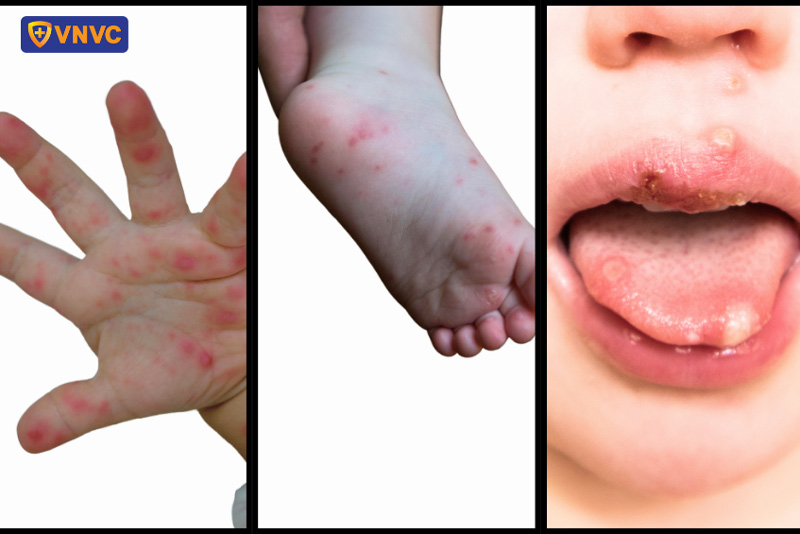tay chân miệng lây qua đâu